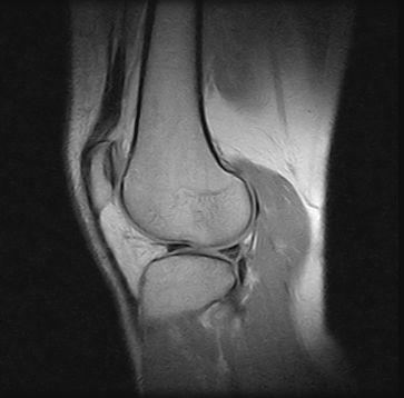 Ressonância Magnética do Joelho no ABC