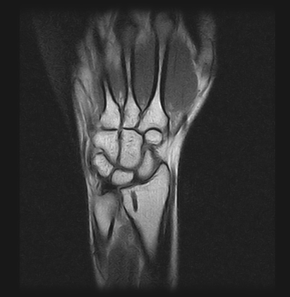 Ressonância Magnética do Punho na Zona Leste