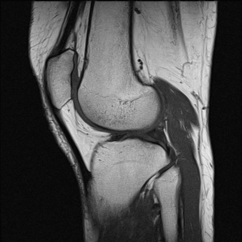 Ressonância Magnética em Joelho Esquerdo