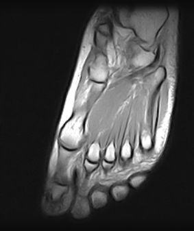 Ressonância Magnética Pé Quebrado