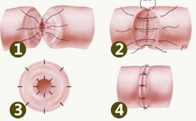 Reversão de Vasectomia Cauterizada