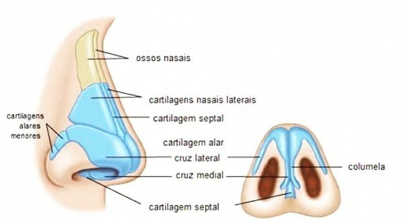 Rinoplastia para Nariz de Batata