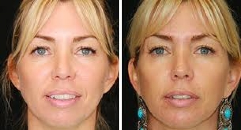 Sculptra para Cicatriz de Acne