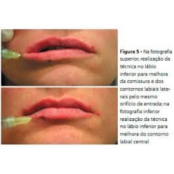 Sessão de Preenchimento Facial