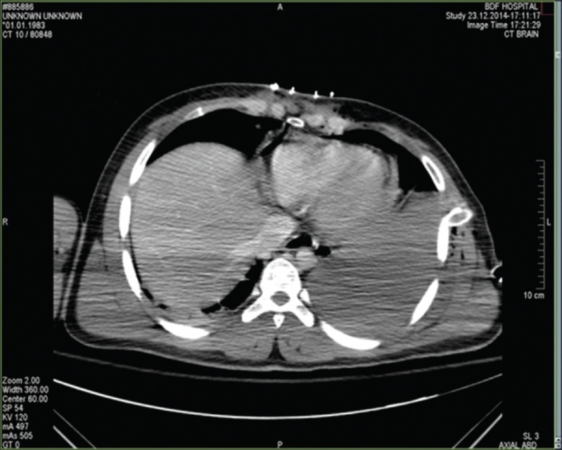 Tomografia Abdominal com Contraste