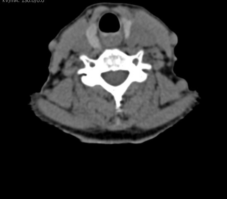 Tomografia Cervical