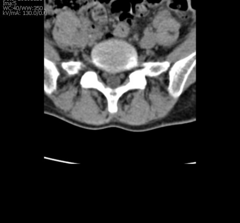 Tomografia Helicoidal