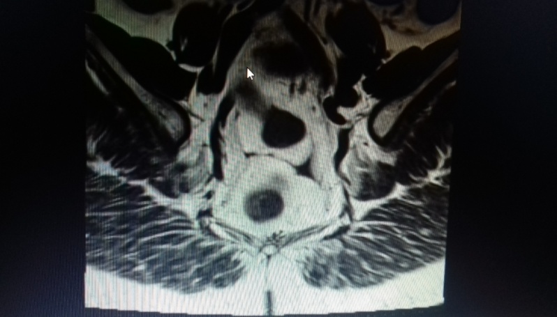 Tomografia para Cálculo Renal