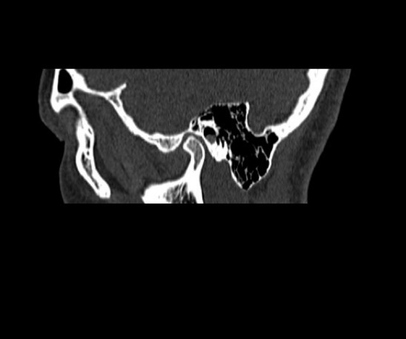 Tomografia Pulmonar