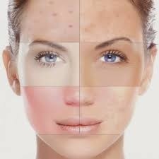 Tratamento a Laser para Marcas de Acne