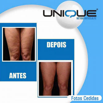 Tratamento de Celulite com Carboxiterapia