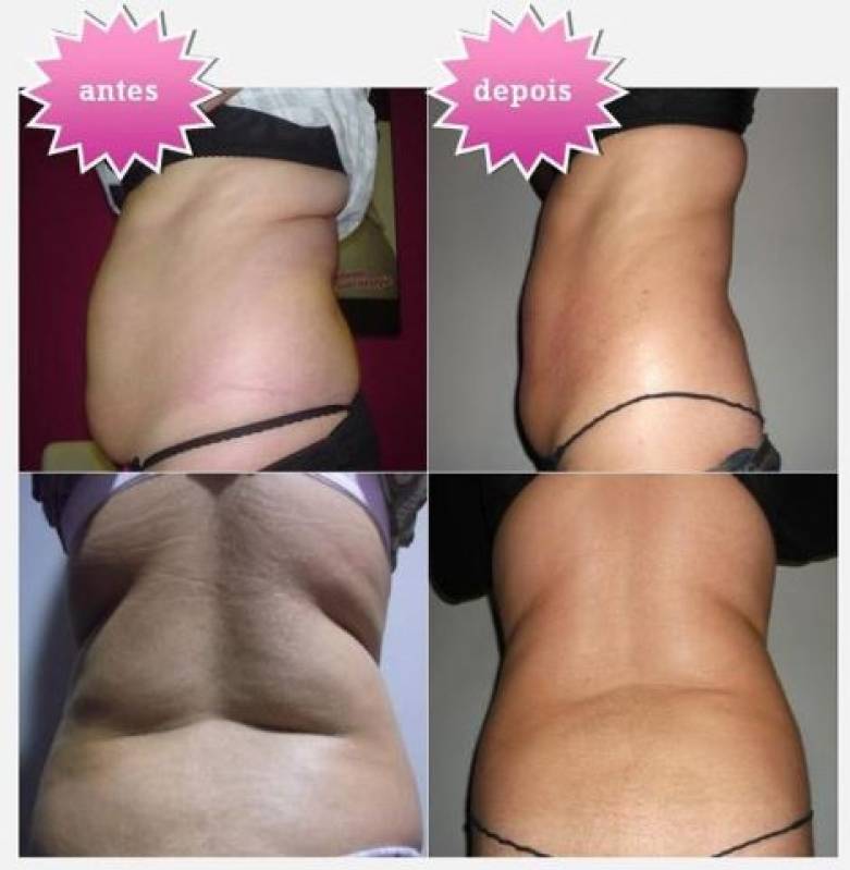 Tratamento de Lipocavitação para Celulite