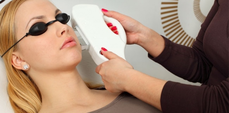 Tratamento de Melasma a Laser