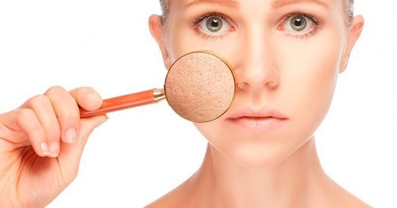 Tratamento de Melasma Laser