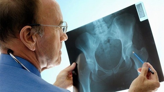 Tratamento de Osteoartrose de Quadril