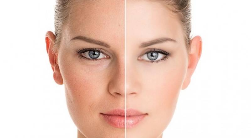 Tratamento de Peeling Químico