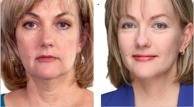 Tratamento Facial Flacidez