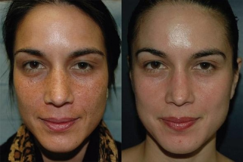 Tratamento Facial para Cicatrizes