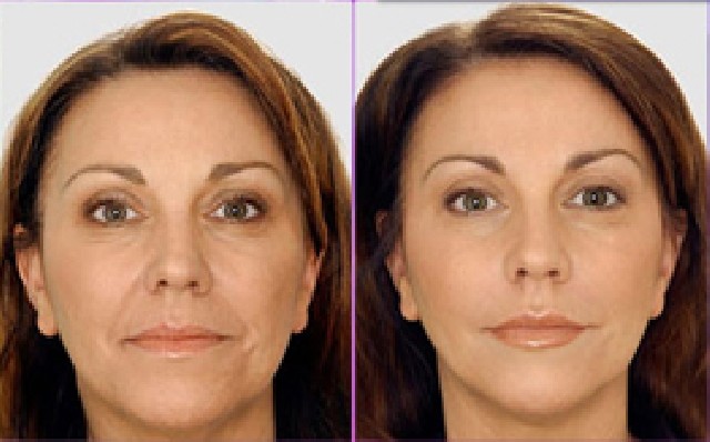 Tratamento Facial Radiofrequencia