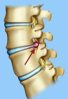 Tratamento Hérnia de Disco
