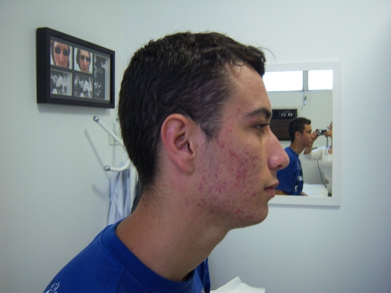 Tratamento para Acne e Cicatrizes
