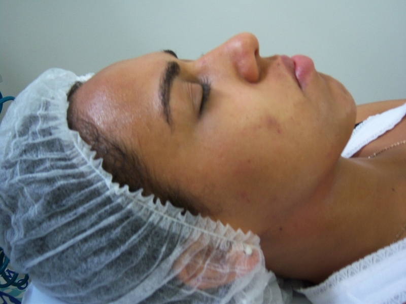 Tratamento para Acne e Manchas na Pele
