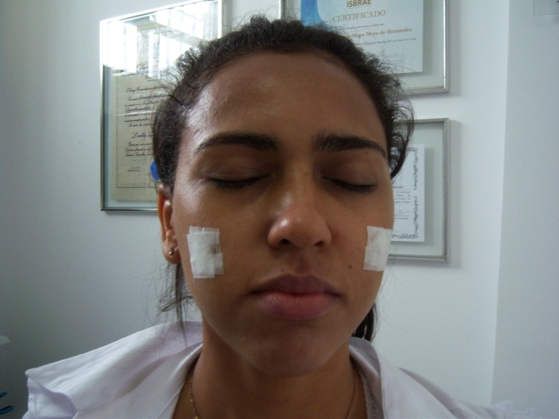 Tratamento para Acne Grau 2