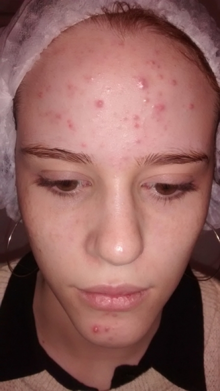 Tratamento para Acne nas Costas