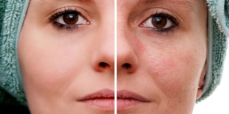 Tratamento para Acne Rosácea