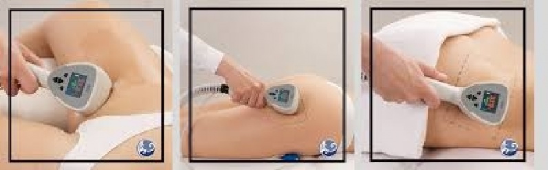 Tratamento para Celulite com Exilis