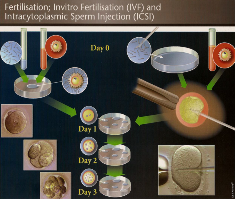 Tratamento para Engravidar In Vitro