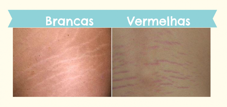 Tratamento para Estrias Estética