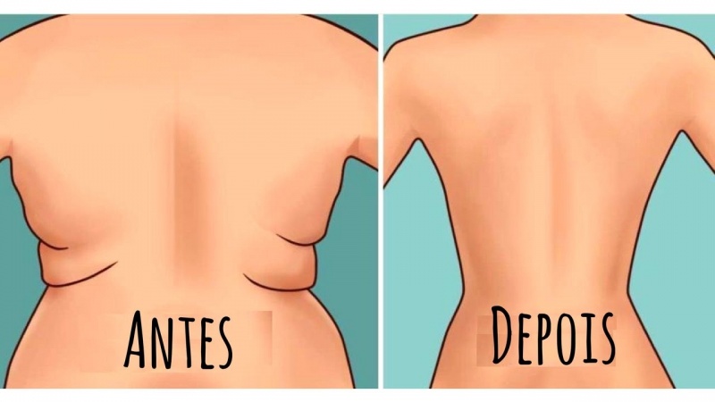 Tratamento para Gordura Localizada Abaixo da Nuca
