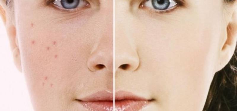 Tratamento para Marcas de Acne