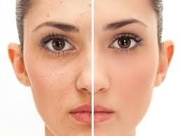 Tratamento para Marcas de Acne no Rosto