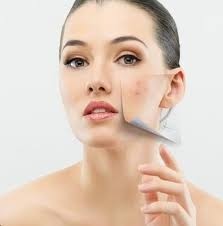 Tratamentos para Cicatriz de Acne