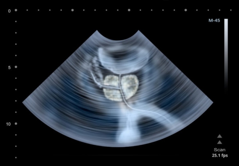 cancer de prostata ultrassonografia despre cele mai importante veruci genitale
