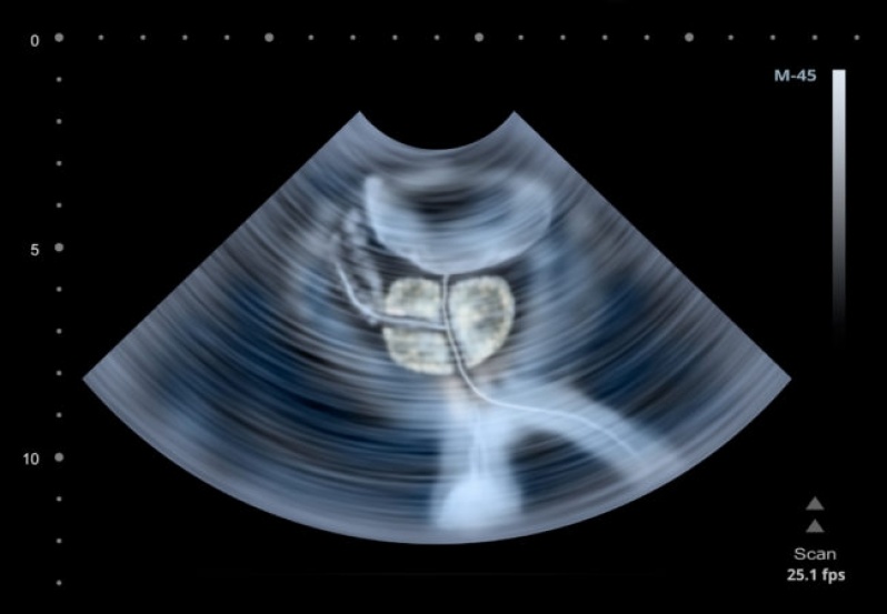 Ultrassonografia Câncer de Próstata