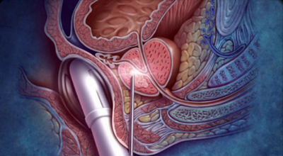 Ultrassonografia Próstata Transretal com Doppler