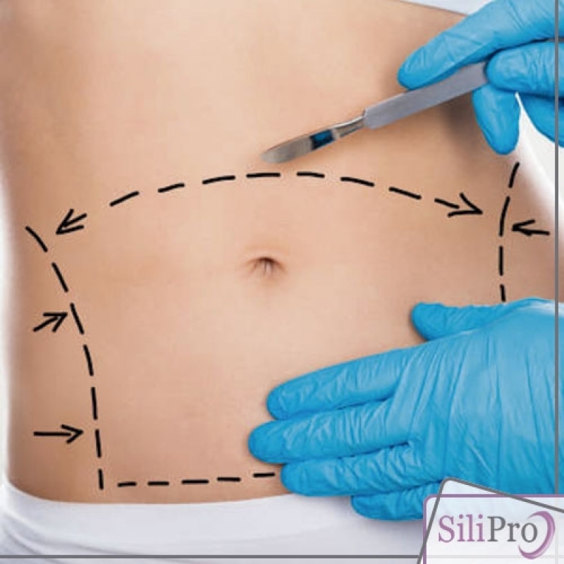 Umbigo de Abdominoplastia