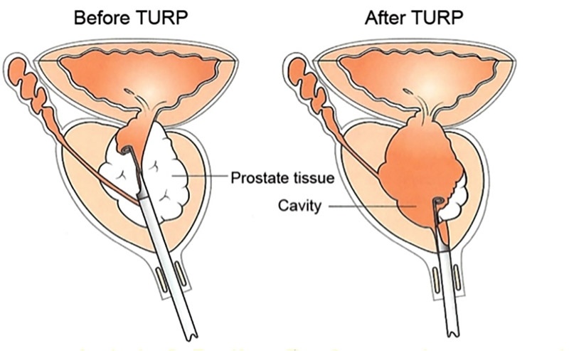 Urologia Cirurgia Peniana