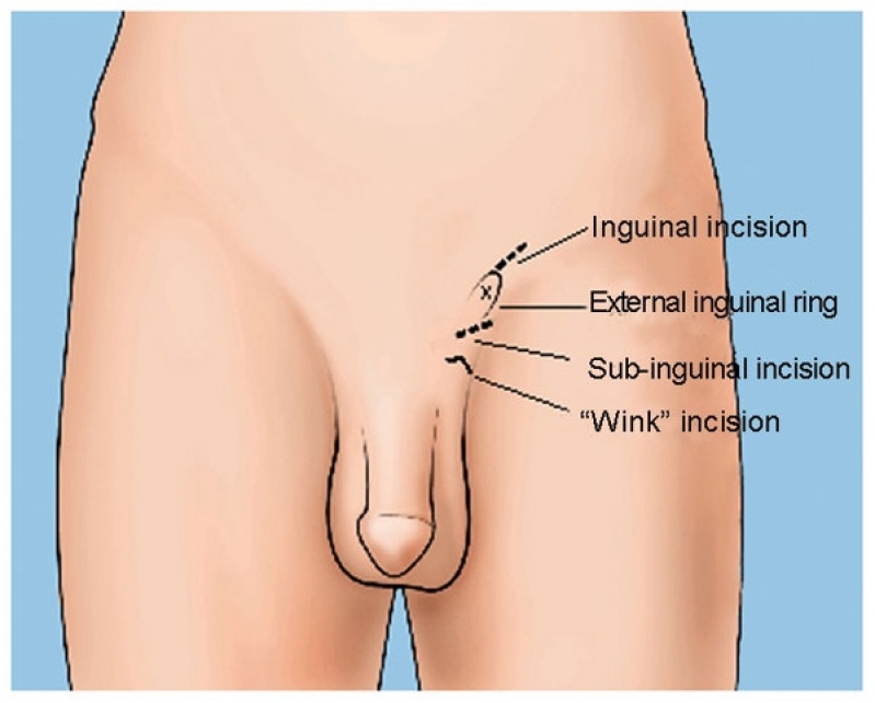 Urologia Cirurgia Varicocele