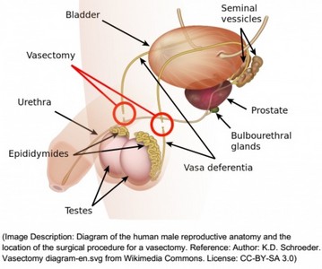 Vasectomia em Hospital Particular