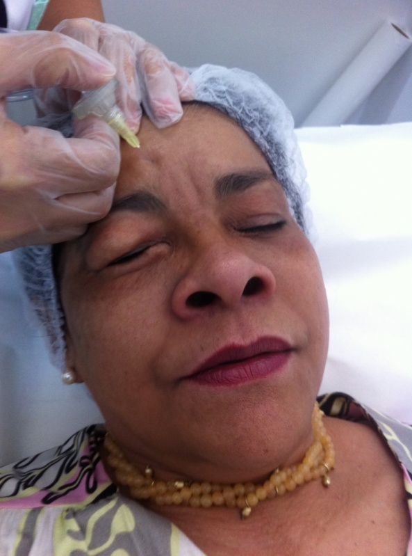 Aplicação de Botox Abaixo dos Olhos