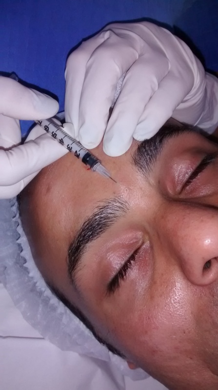 Aplicação de Botox Corporal