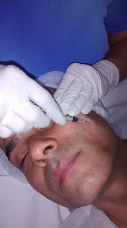 Aplicação de Botox para Enxaqueca