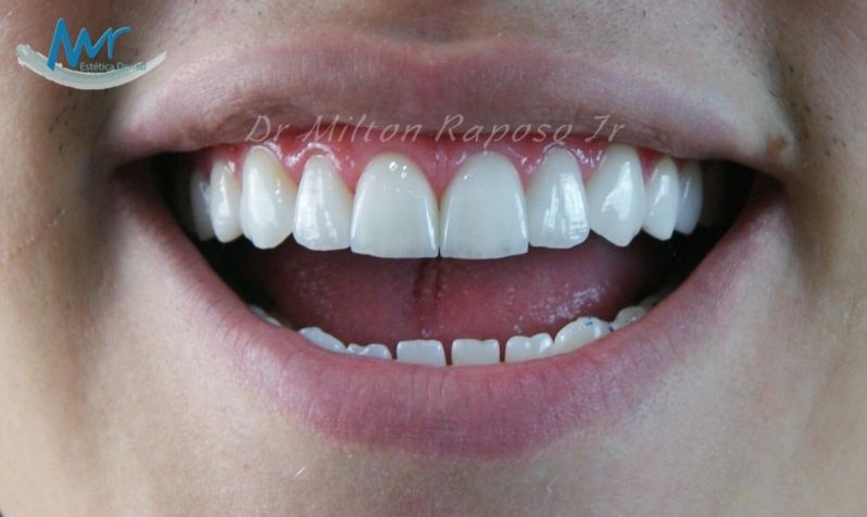 Aplicação de Facetas nos Dentes