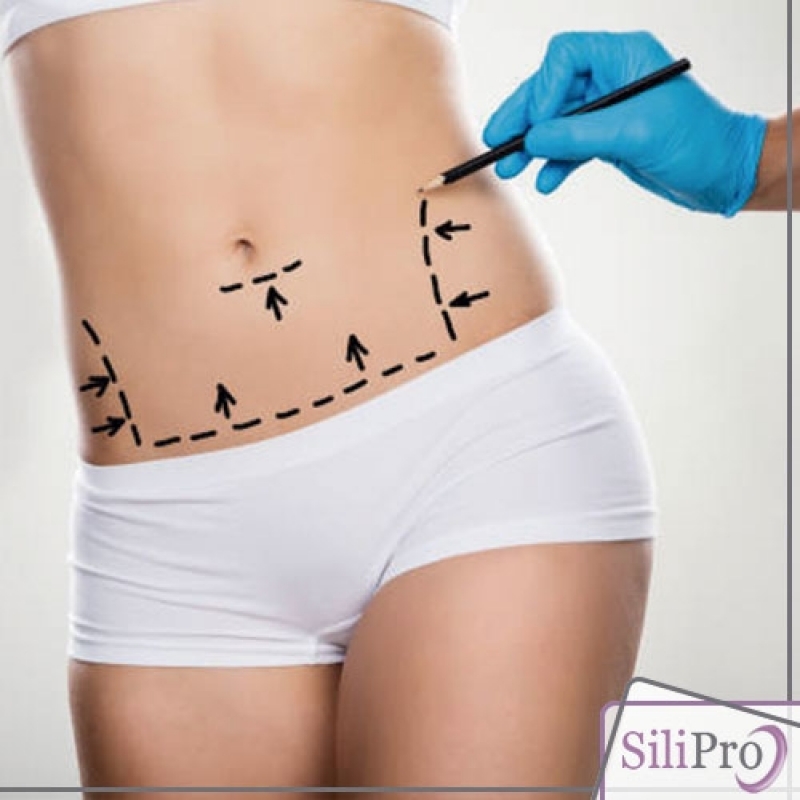 Cicatriz de Abdominoplastia