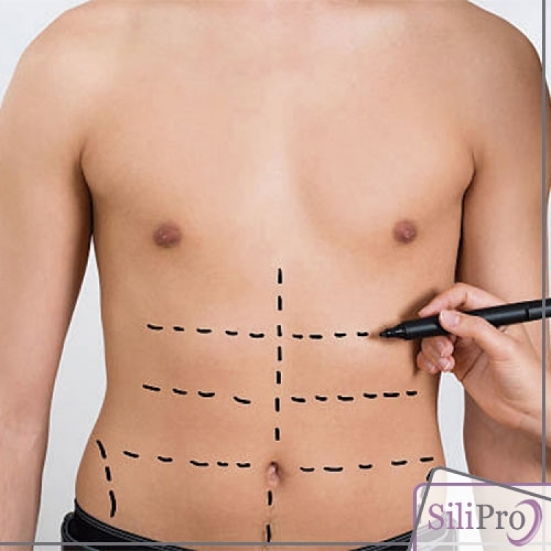 Cirurgia de Abdominoplastia