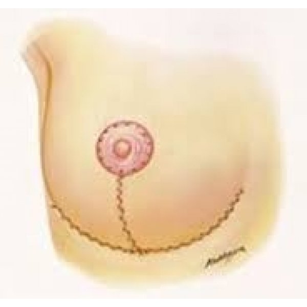 Cirurgia de Mamoplastia
